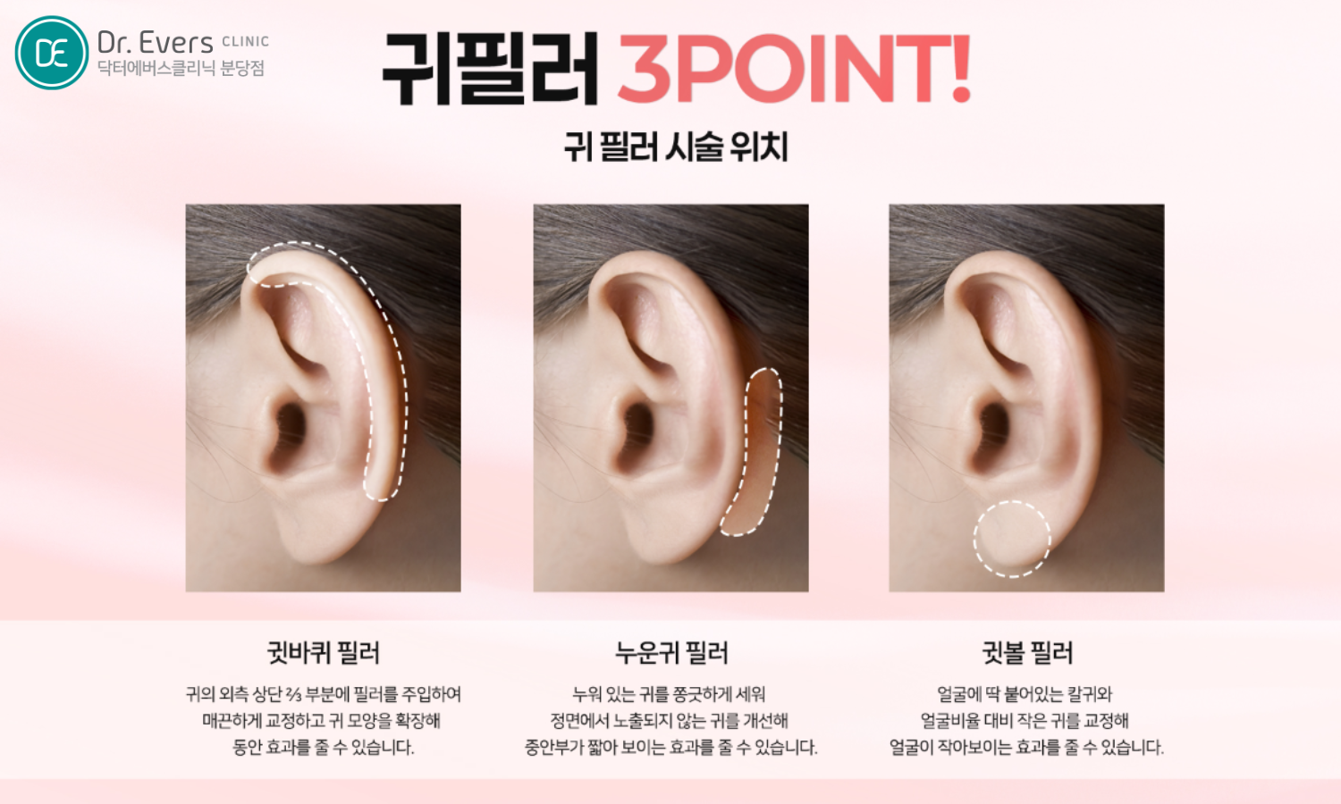엘프 귀 필러_닥터에버스의원 분당점